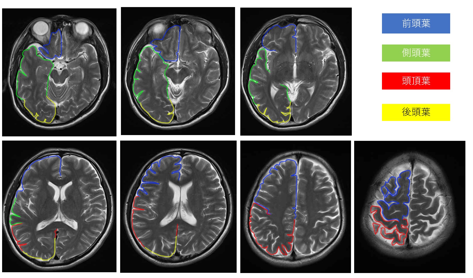 2022年最新】後頭葉の機能・症状とリハビリ、視機能、眼球運動障害と