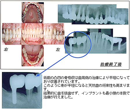 歯周病患者さんにインプラントは可能か：2 | インプラントや歯周病治療