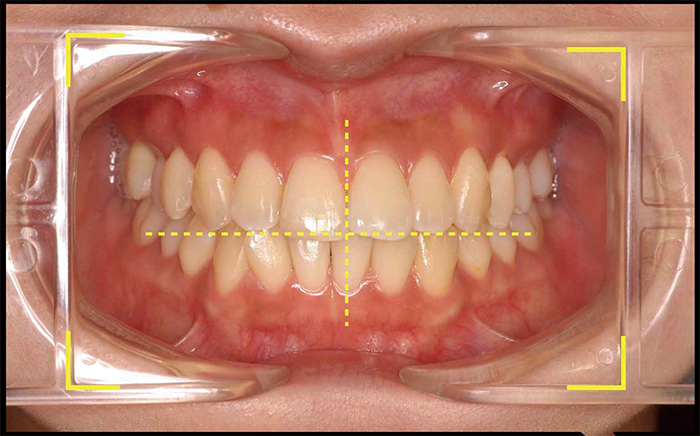 フォトガイダー｜ 検査 / 麻酔 / 知覚過敏抑制材料｜治療｜製品情報