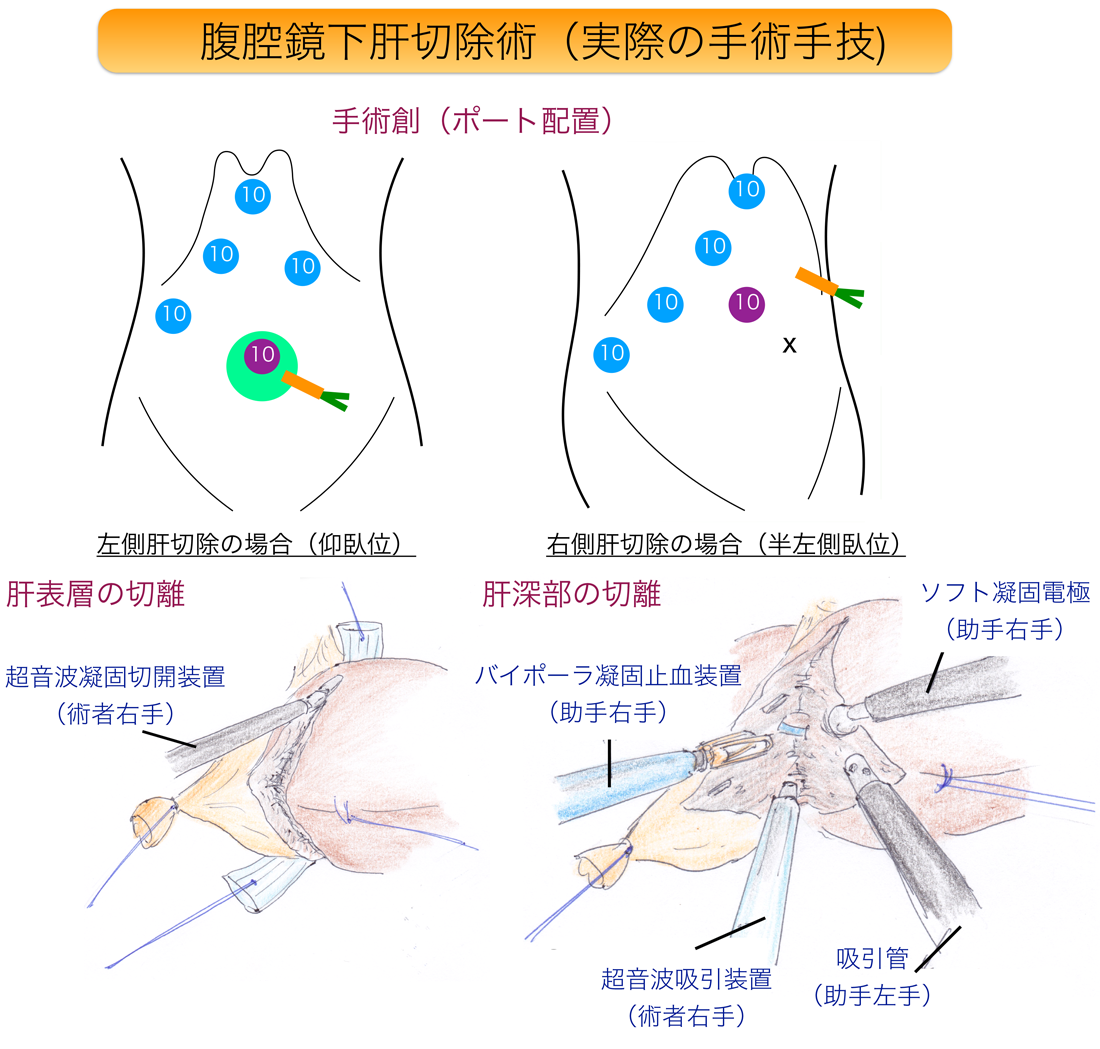 肝臓の主な病気と診療実績〈低侵襲肝切除術（腹腔鏡下肝切除術