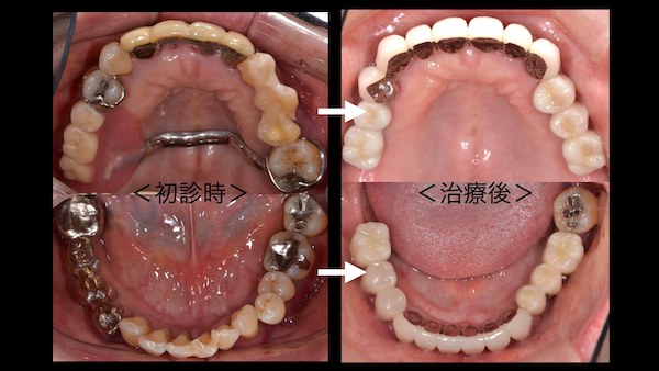 症例】歯周病に対するインプラント治療｜港南台パーク歯科クリニック