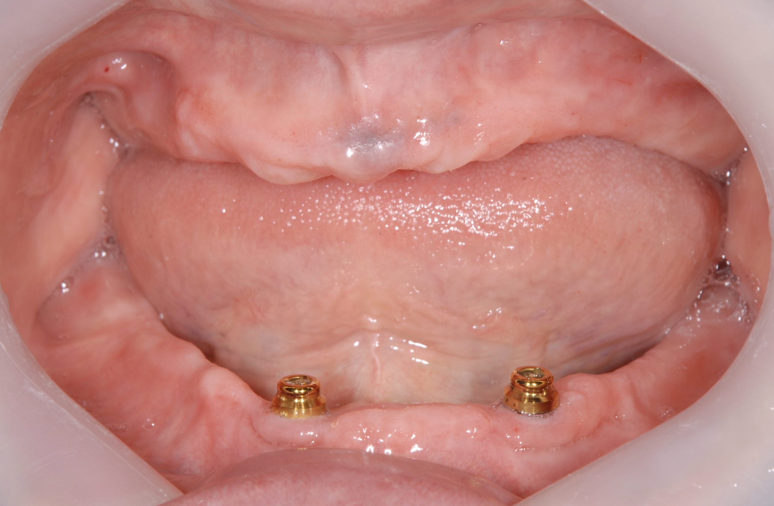 症例】歯周病で総入れ歯になった方へおすすめ！インプラントを用いた