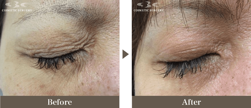 サーマクールFLX/CPT｜医療レーザー外来なら湘南美容クリニック【公式】