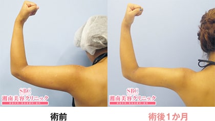 美ボディ脂肪吸引｜脂肪吸引なら湘南美容クリニック【公式】