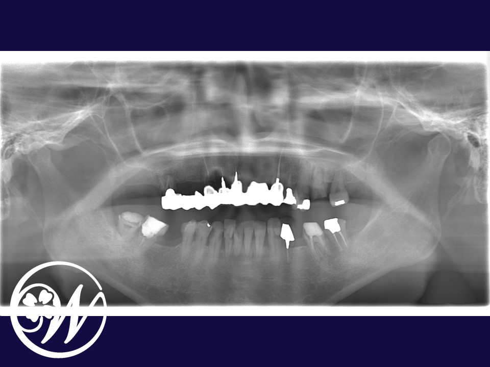 症例】【多数歯欠損をインプラント治療にてリカバリーした全顎症例