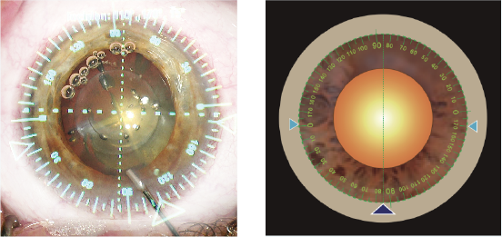 新時代の白内障手術システムPerfect Z-CATARACT System - 白内障手術