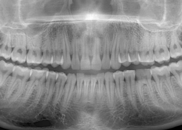 低被ばくのデジタルレントゲンを導入｜喜んでいただいている10の理由