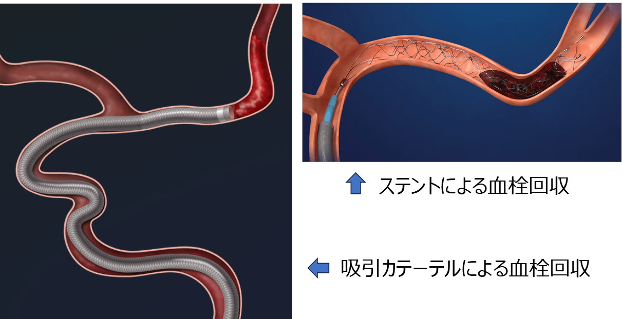 脳血管内治療 | 先進的医療 | 高松赤十字病院 - 日本赤十字社 [香川県]
