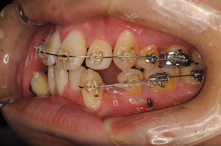 宮崎県の「たけお矯正歯科」歯科矯正用アンカースクリューを使った矯正