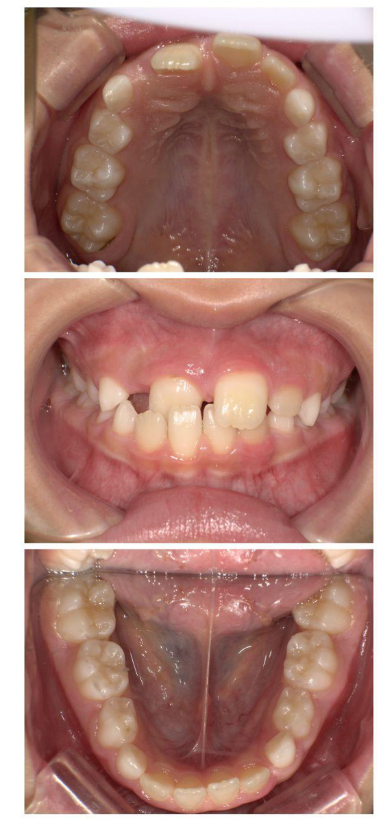 前歯が1本だけ反対になっている（1歯反対咬合・交叉咬合）｜たんぽぽ