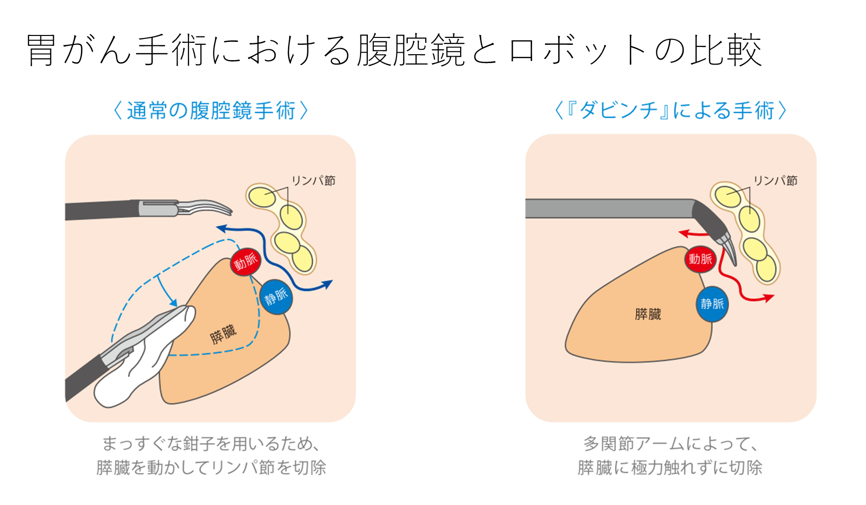 腹腔鏡下・ロボット支援下胃切除術 - 総合病院 土浦協同病院