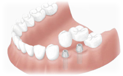 インプラント - 大阪市 北区の歯科 THINK TOOTH（シンクトゥース）