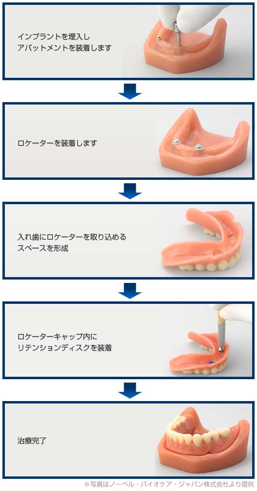インプラント・ロケータ - 大阪府門真市にある堤デンタルクリニック