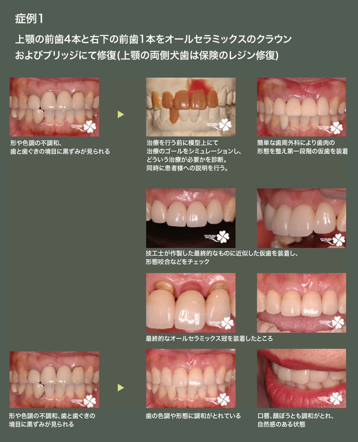 審美補綴歯科治療について | 中百舌鳥・なかもずの歯医者、松井歯科