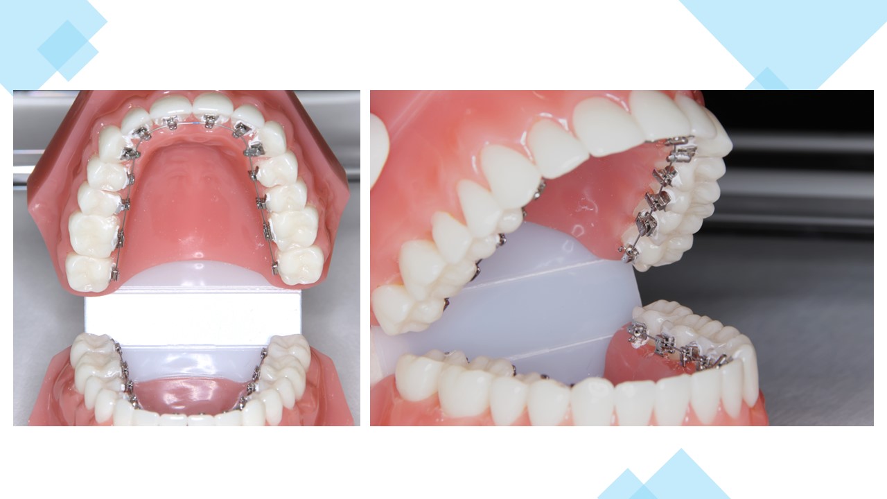 裏側矯正（リンガル矯正）を始めた方へ｜装置の特徴と日常生活の注意点