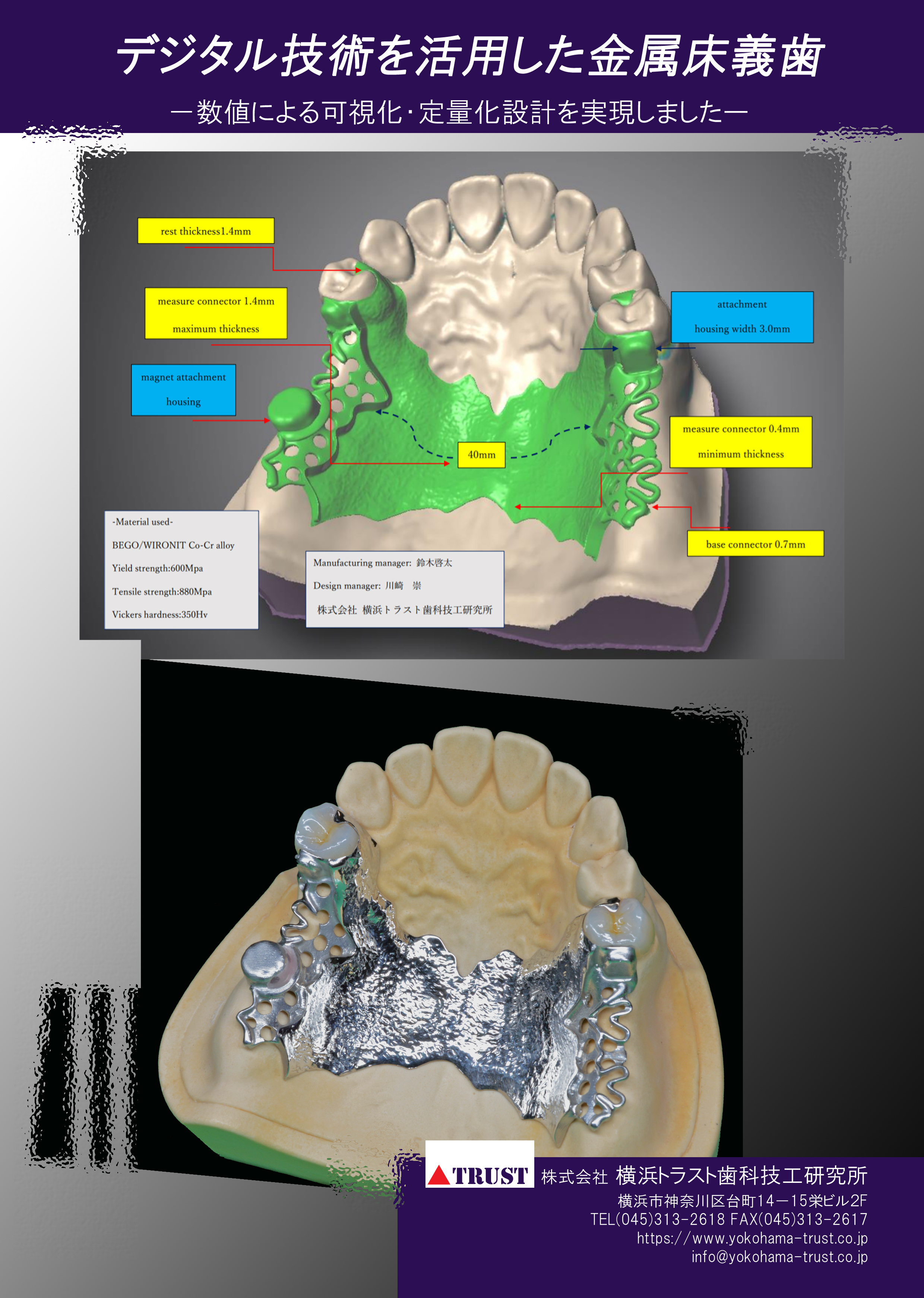 デジタル金属床義歯のパンフレットを作成しました - 横浜トラスト歯科