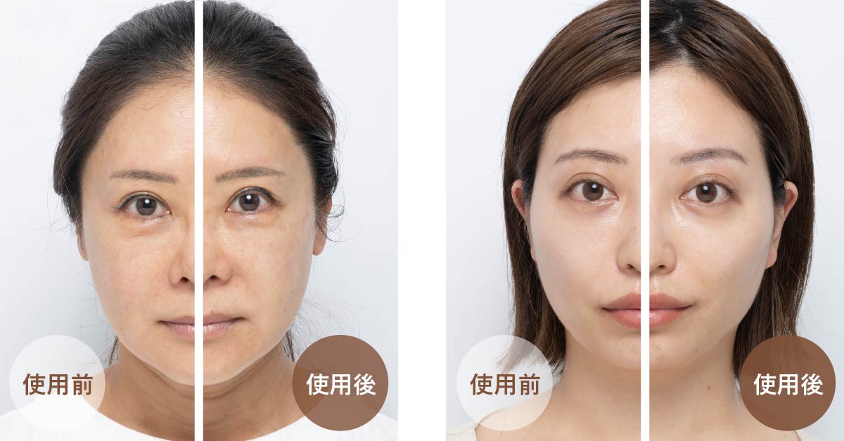 製品特長| 「RF美顔器 フォトプラス シャイニー ネオ」高浸透