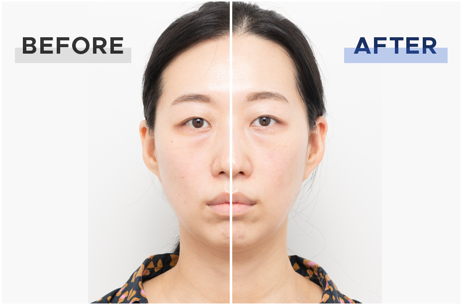 ハイパーフェイスリフトブラシ｜進化したリフトケア｜ヤーマン