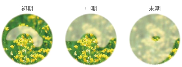 All About 開放隅角緑内障 All About 開放隅角緑内障 第2版 | 書籍詳細