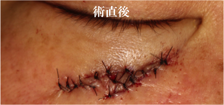 Scar Revision （瘢痕形成術） – 医療法人 双英会 YUKI皮フ科形成外科