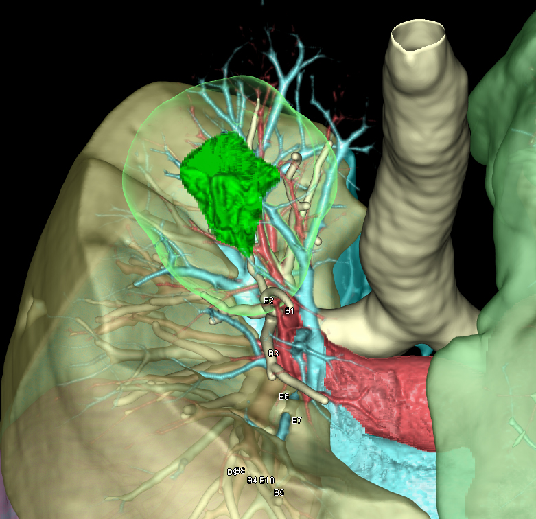 肺切除解析｜手術シミュレーション｜REVORAS