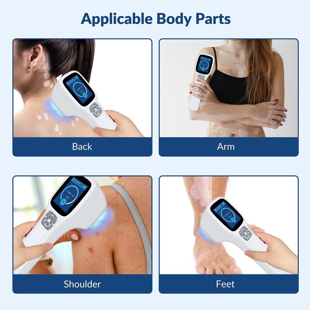 308nm Excimer Uvb Light Therapy Home Use Phototherapy Device for