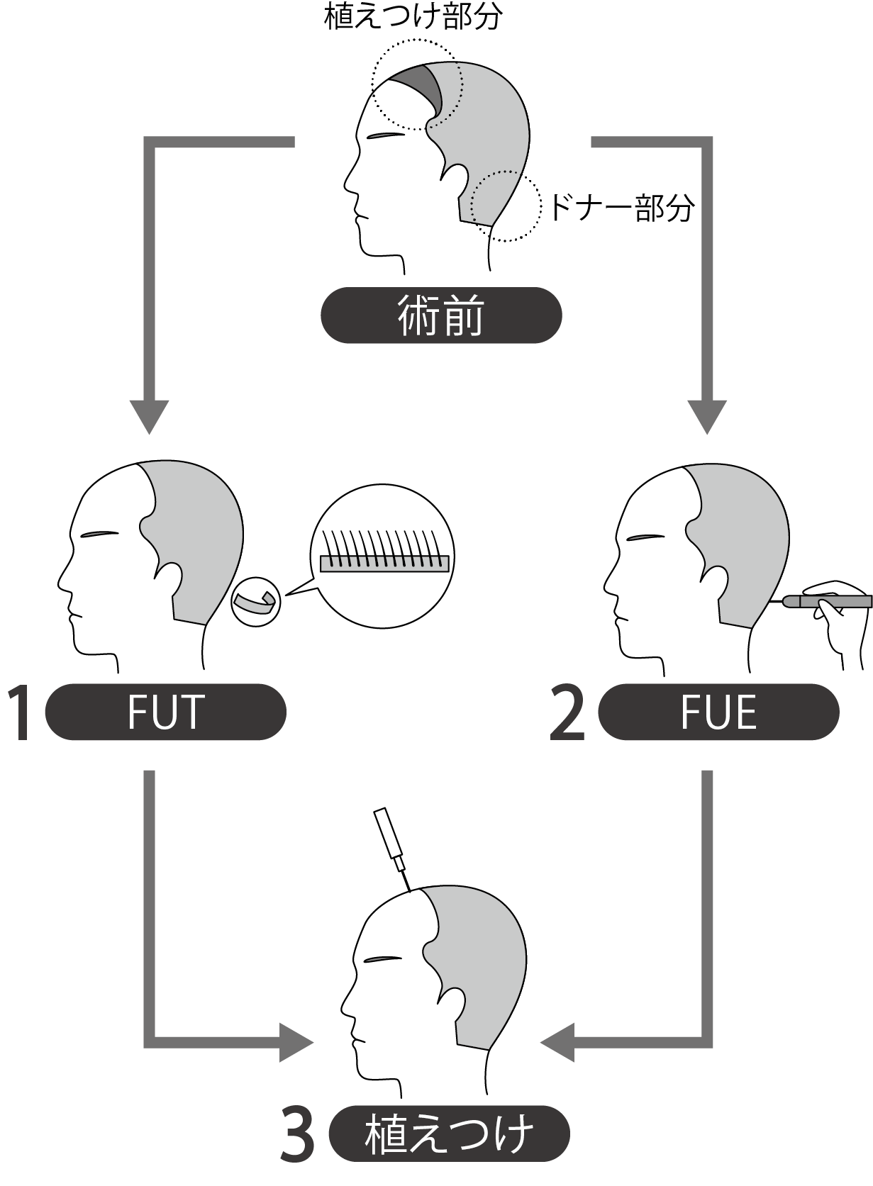 植毛治療の流れ | 横浜・首都圏の自毛植毛・植毛の専門医、ヨコ美