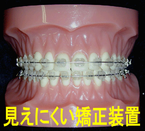顎変形症 装置 ブラケット | 横浜 矯正歯科｜村田歯科・横浜矯正歯科