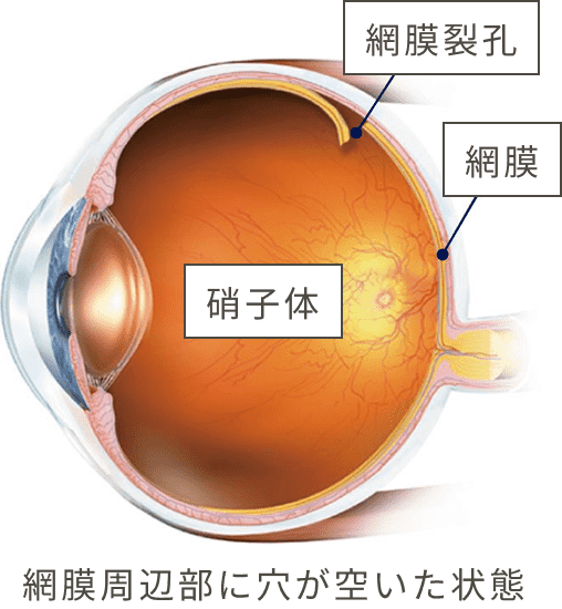網膜剝離の前兆は？｜見逃しやすい初期症状と3つの治療法｜横浜・きく