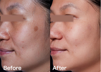 美肌・シミ・くすみ | 美顔レーザ－ | 顔・体のシミ取り | ピコ