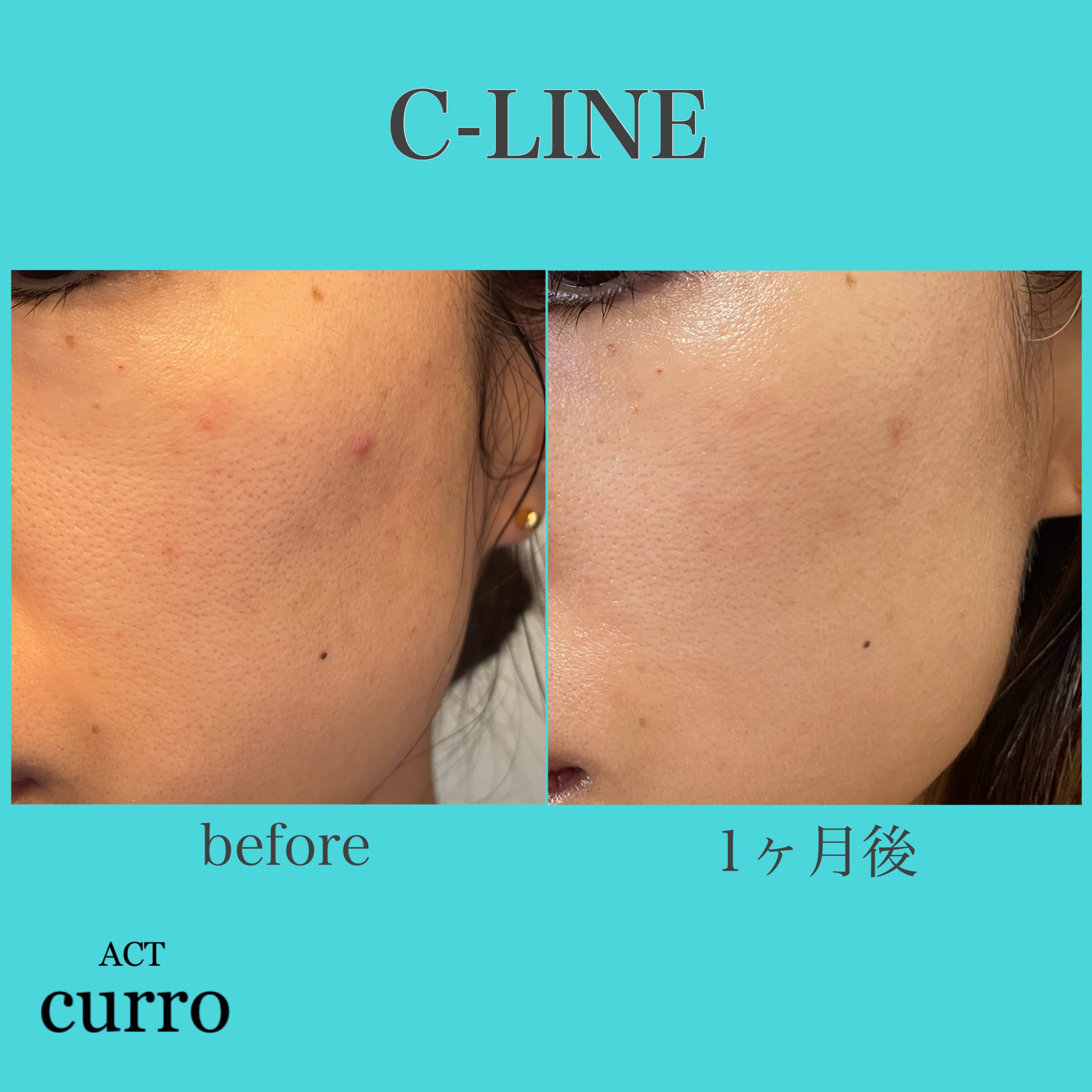 スピケア ✨C-LINEシリーズ✨1ヶ月経過報告🙌 – ACT CURRO（アクト クロ）