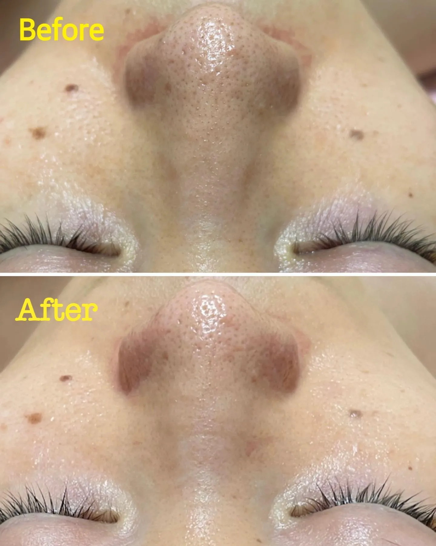 毛穴の洗浄〜ハイドロスプラッシュ〜 | ブログ | 埼玉のエステなら