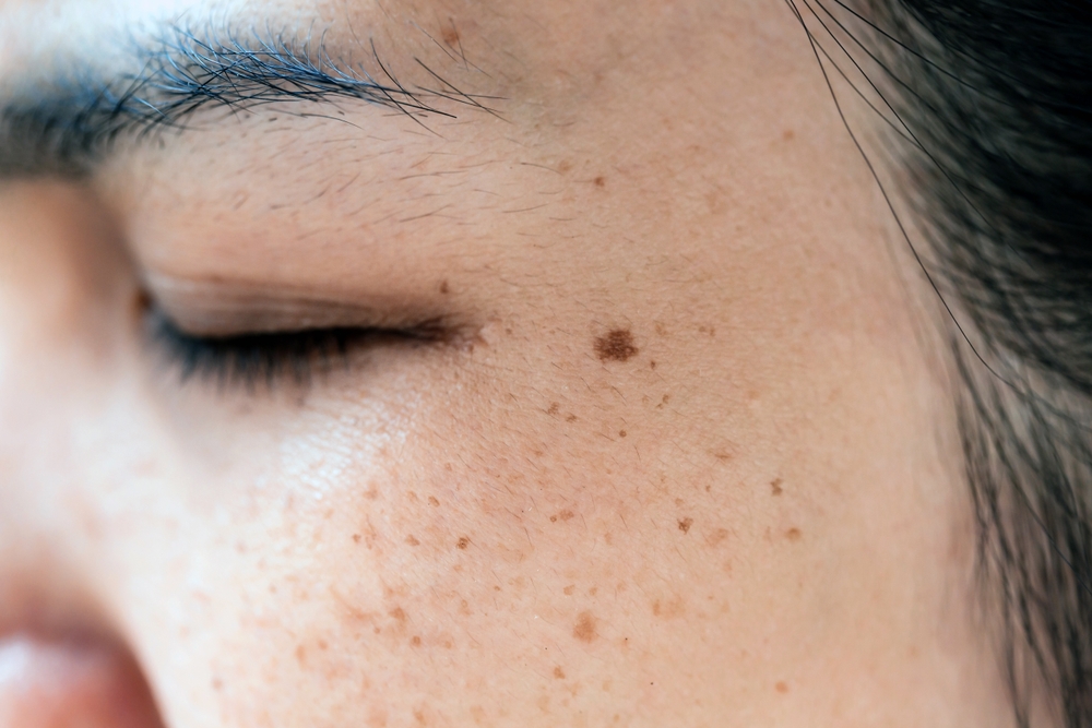 シミの種類と見分け方を徹底解説！治療法やケアも | 東京都上野御徒町
