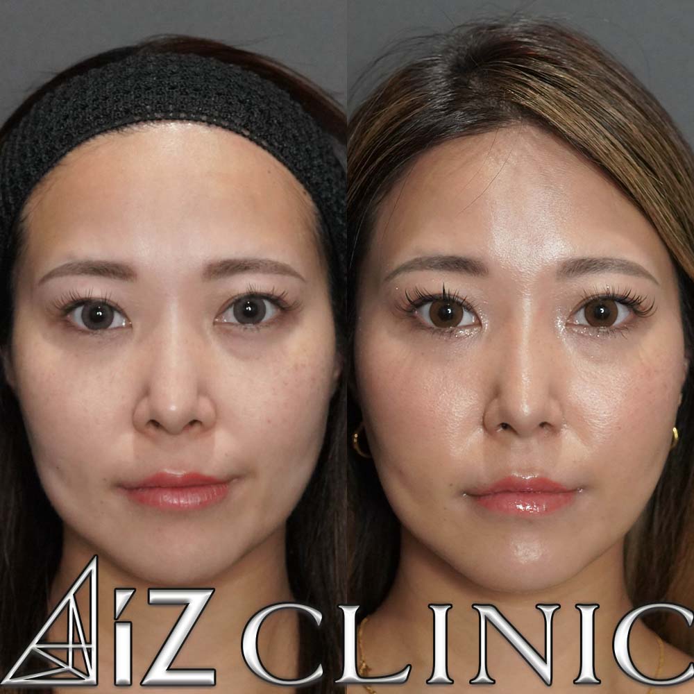 鼻翼縮小で鼻の整形なら美容外科・美容皮膚科AiZクリニック ｜AiZ