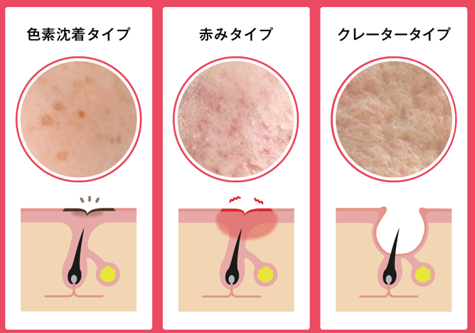 毛穴・ニキビ跡｜阿佐ヶ谷で美容皮膚科ならあおい皮フ科クリニック