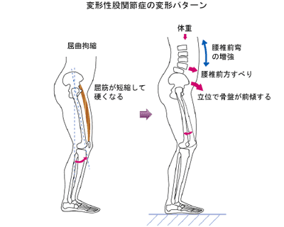 変形性股関節症・膝関節症の治療方針｜佐久市立国保浅間総合病院（佐久