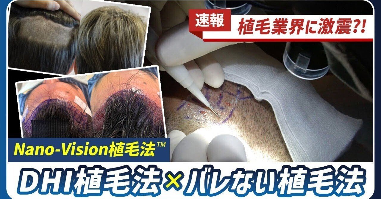 徹底解説】従来のFUE法を超える？！最新植毛治療で理想の髪型を手に