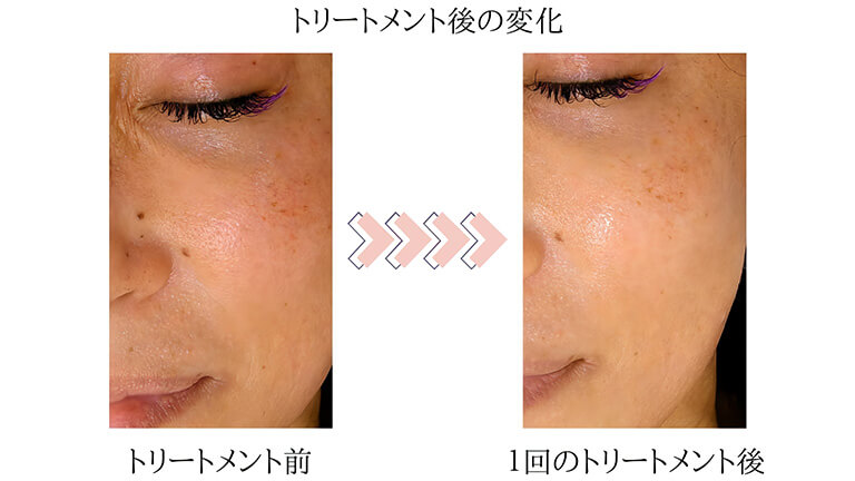 WiQoワイコ水光ピール ダウンタイムなしの肌改善｜中野の歯医者