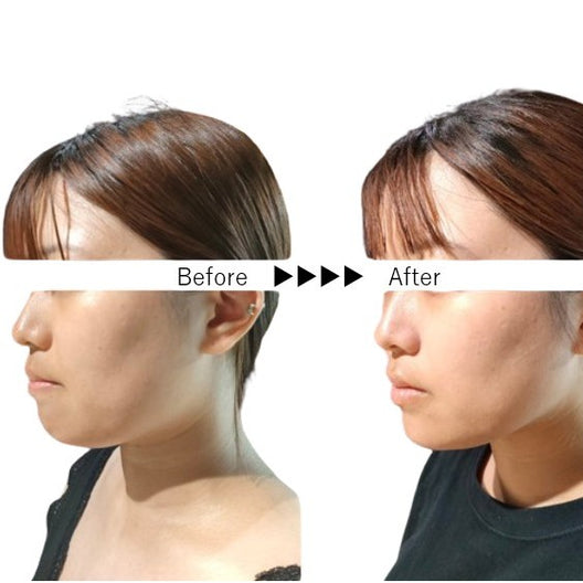 レモンボトル（脂肪溶解美容液）10ml × 5本入り 【クーポンコードご