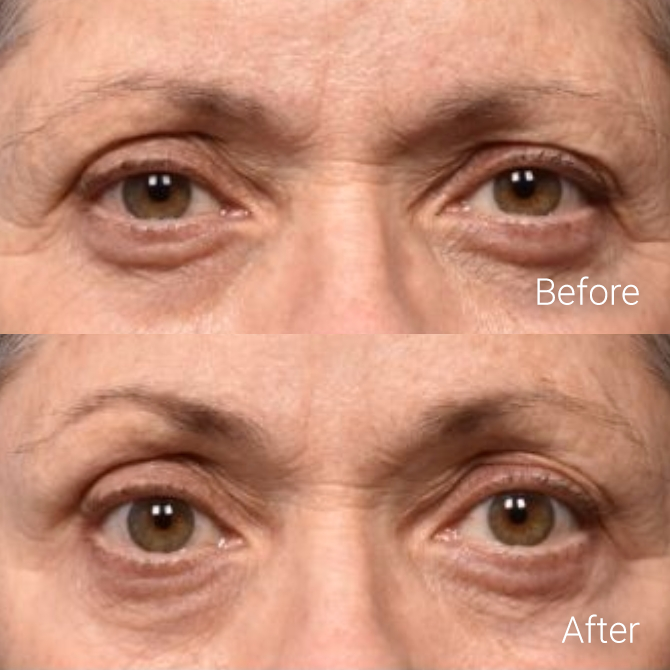 Non-Surgical Skin Tightening - Livingston, NJ | Berlin Beauty