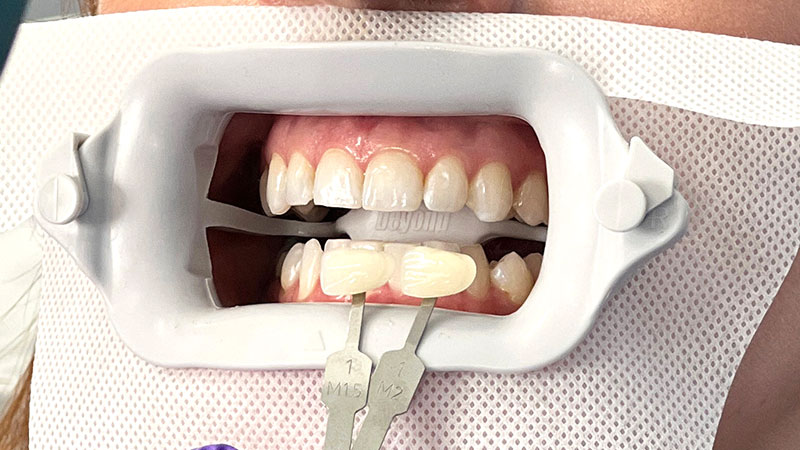 How to use - beyond Whitening | 株式会社JBAbeyond Whitening | 株式