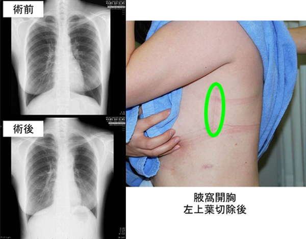 肺がん – 愛知県がんセンター