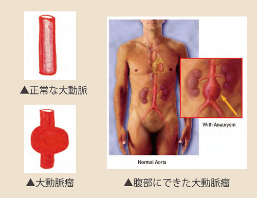 ステントグラフト内挿術｜名古屋徳洲会総合病院 循環器内科特設サイト