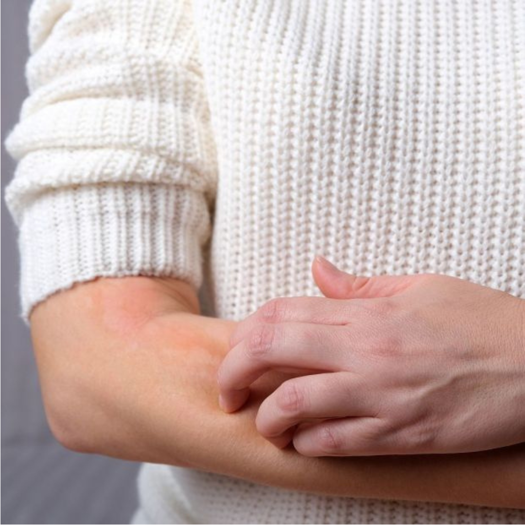 Eczema Treatment for Sensitive Skin by CLMD – Cheryl Lee MD