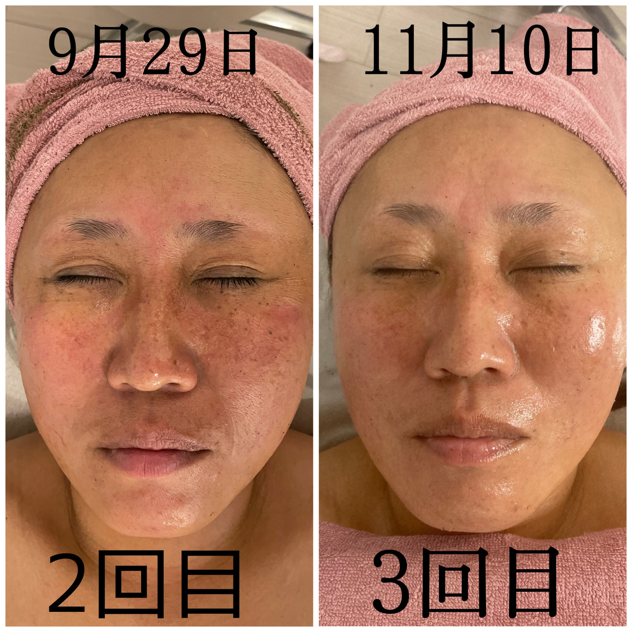 枚方/交野美肌専門サロンでREVI 陶肌トリートメント