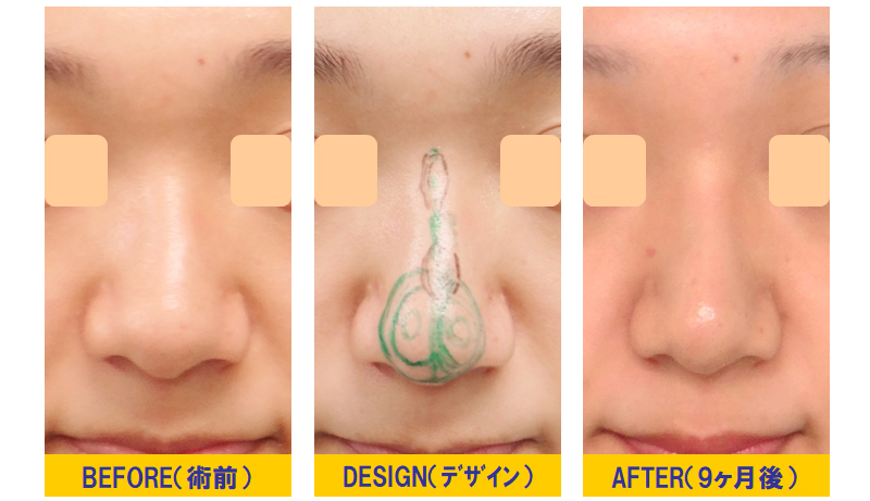 鼻整形「ウェーブ鼻・ワシ鼻の修正 完全CLOSE法 鼻尖軟骨切除＆再移植