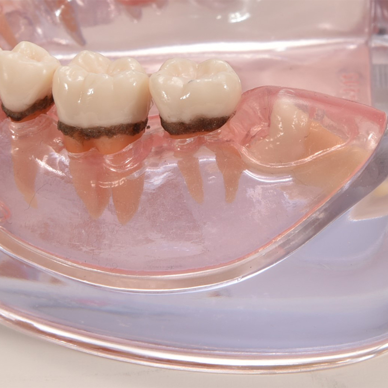 歯周病説明用顎模型 PE-PER004の通販 | Ciモール | Ciモール