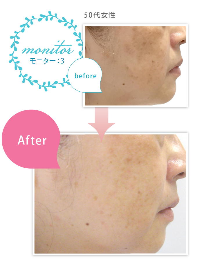 ネイオンビューティー オーパスフェイス