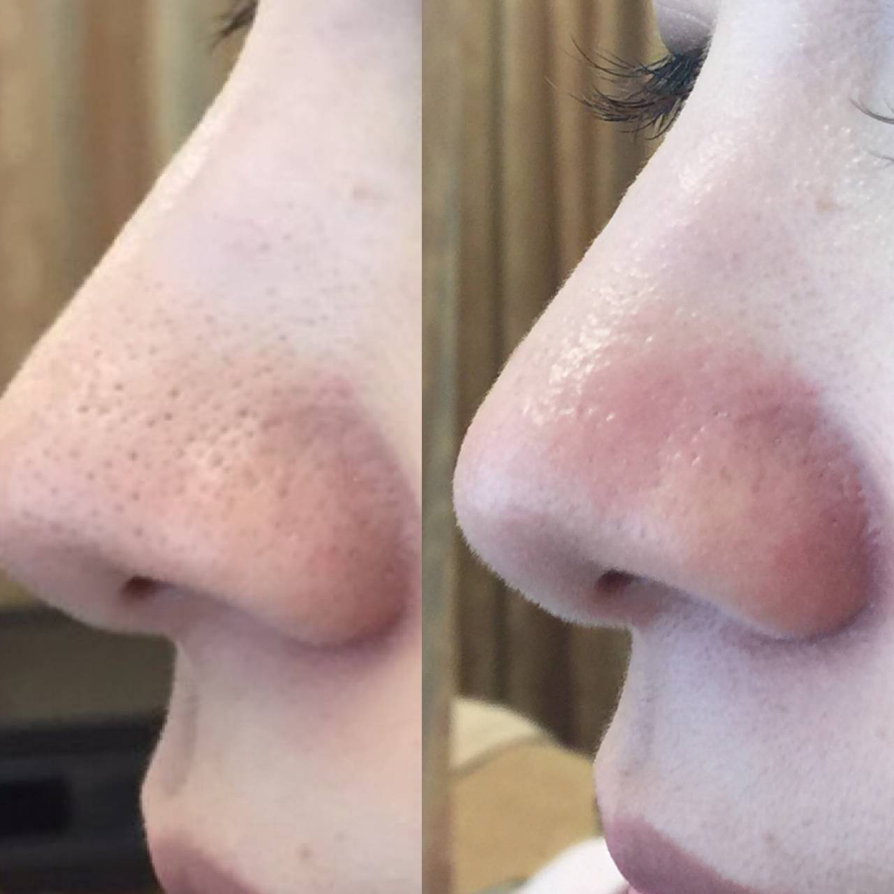 プラズマシャワー・ハイドラフェイシャル・フェイスリフト・毛穴