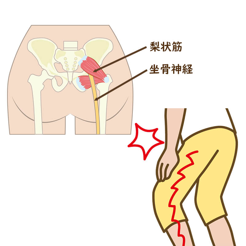 脊柱管狭窄症、椎間板ヘルニアなどによる坐骨神経痛や足のしびれ